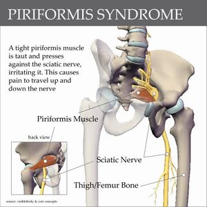 Piriformis syndrome.jpg