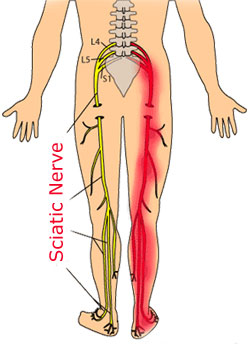 sciatic1.jpg