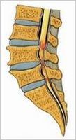 腰部脊柱管狭窄症