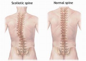 scoliosis.jpg