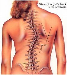 scoliosis2.jpg