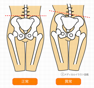 骨盤　正常　異常