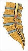 腰部脊柱管狭窄症を側面から見た絵